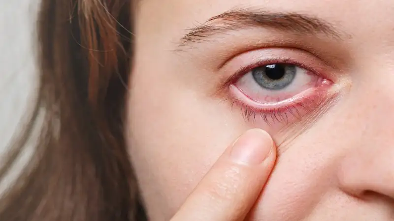What Does an Eye Infection Look Like